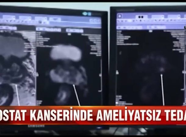 Prostat Kanseri’nde HIFU ile Fokal Terapi