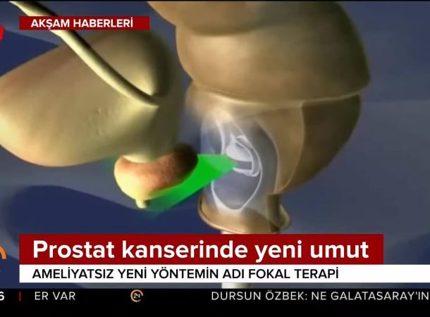 Prostat Kanseri’nde HIFU ile Fokal Terapi