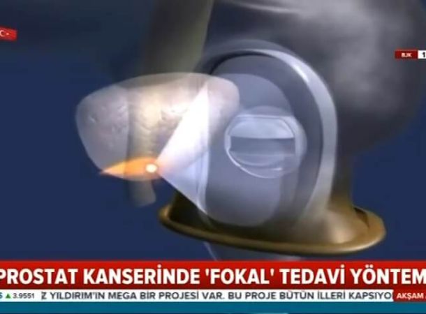 Prostat Kanseri’nde HIFU ile Fokal Terapi