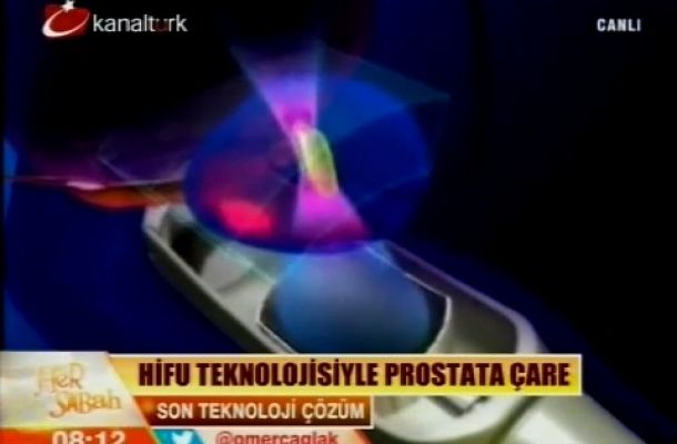 Prostat Kanseri HIFU Tedavisi